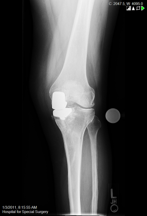 Unicondylar/Partial Knee Replacement