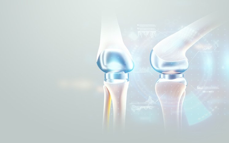 Types of Knee Implants