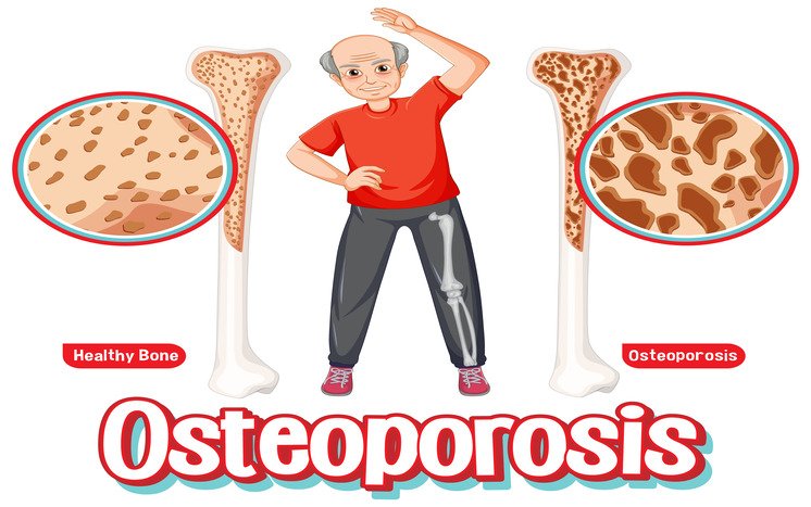 What is Osteoporosis? Symptoms, Causes, and Prevention