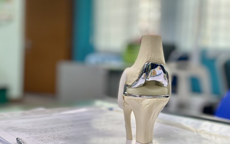 How Surgeons Design Custom Knee Replacements